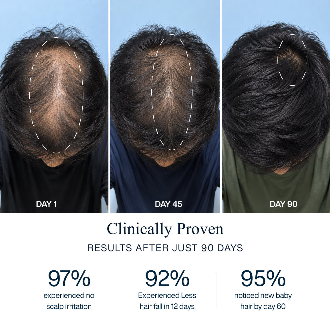 Advanced Copper Peptide Hair Growth Serum | Reduces Hairfall in 14 Days | GHK-Cu + Saw Palmetto + Biotin | 30ml